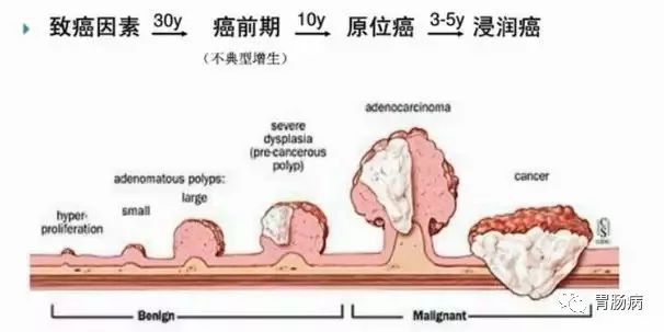 體檢查出腸息肉一定要切除！ 95%腸癌由它演變而來