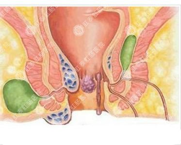 南寧哪個(gè)醫(yī)院可以做肛周膿腫？