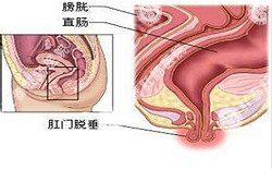 南寧治療脫肛哪家醫(yī)院好？南寧脫肛治療多少錢？